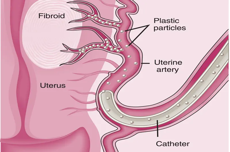 Uterine Fibroids