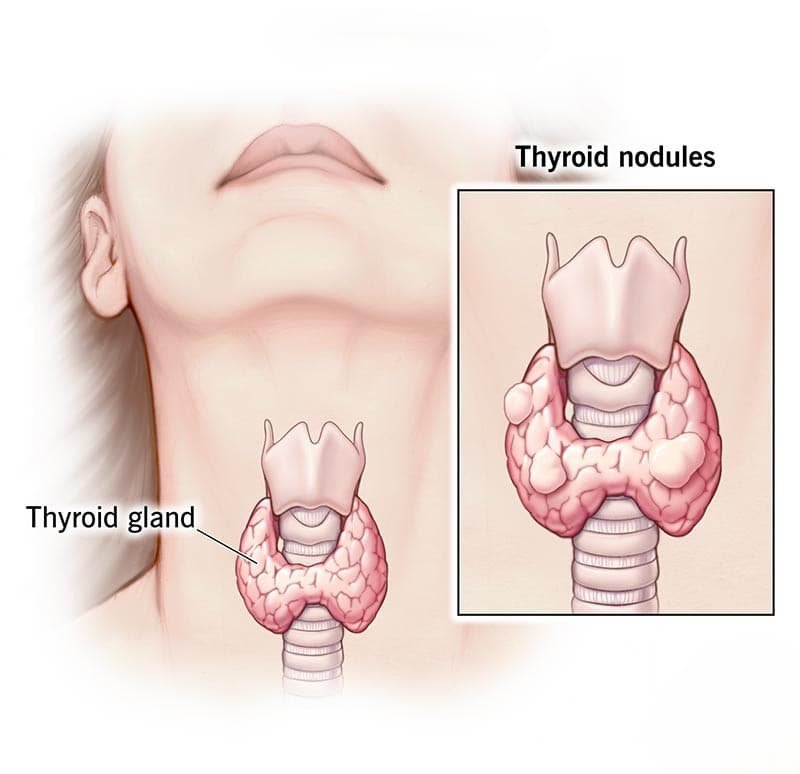 Thyroid Nodule