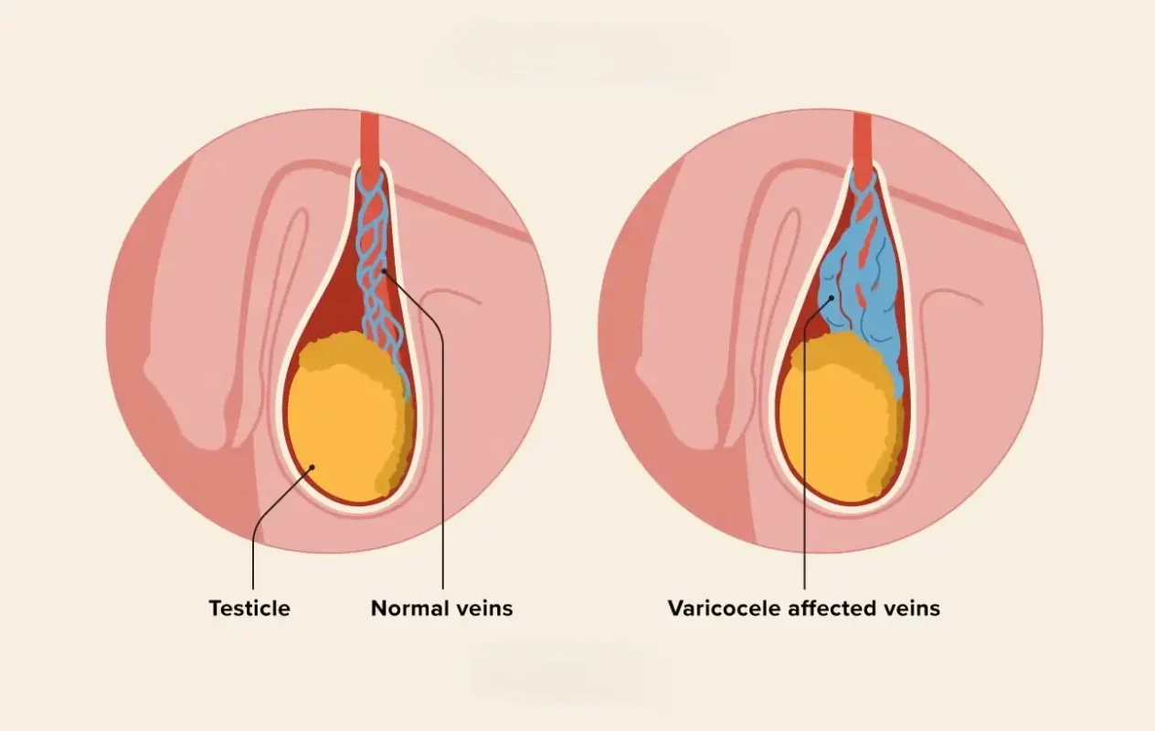 Varicocele