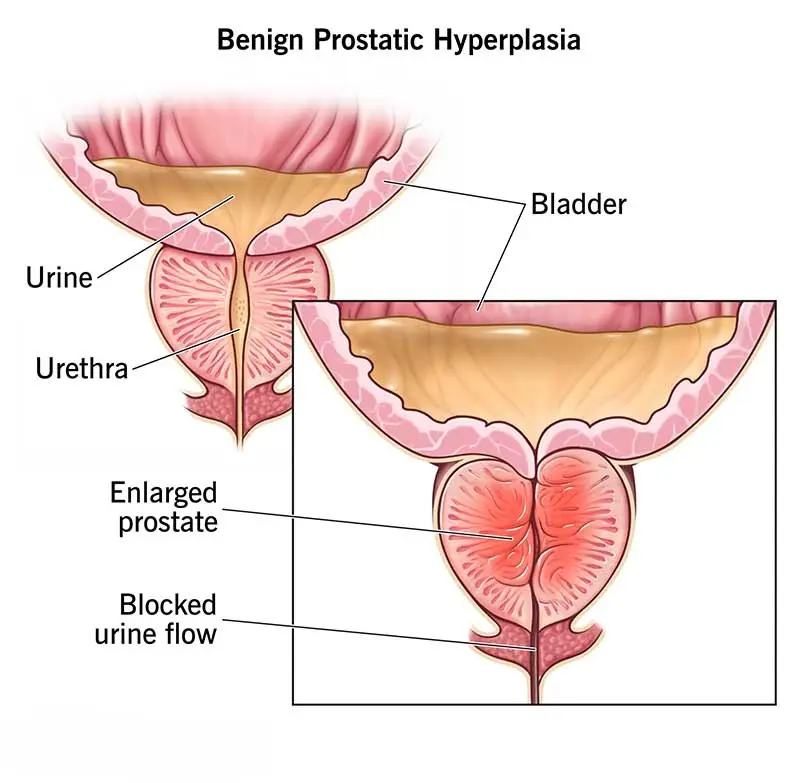 Benign Prostatic Hyperplasia (BPH)