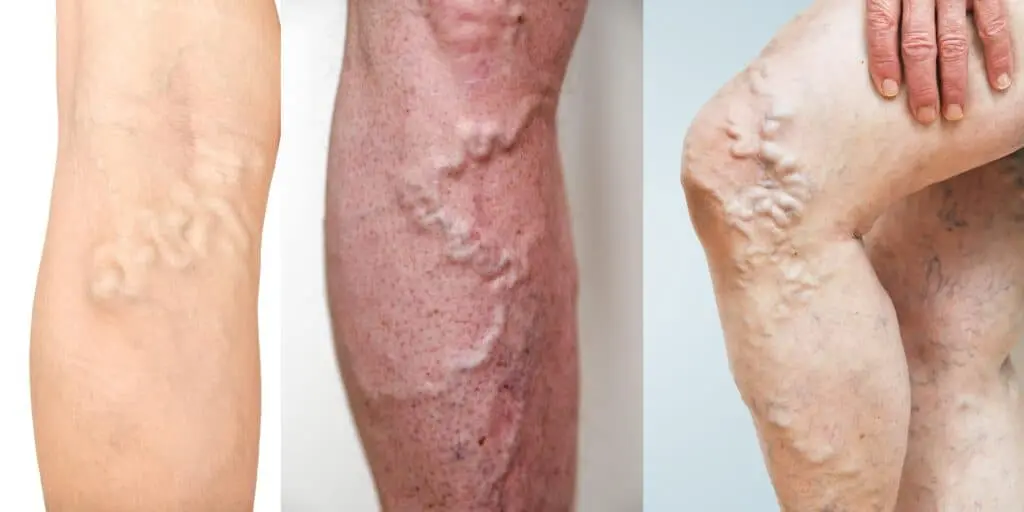 Deep Vein Thrombosis