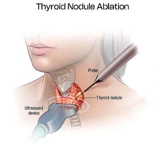 Thyroid Nodule Ablation