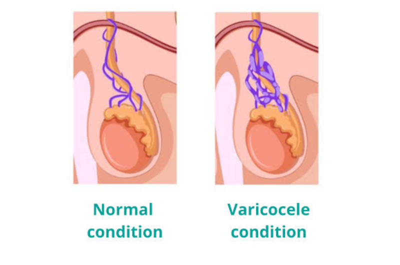varicocele