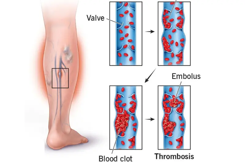 Deep Vein Thrombosis (DVT)