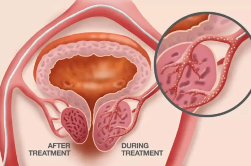 Prostate Artery Embolization