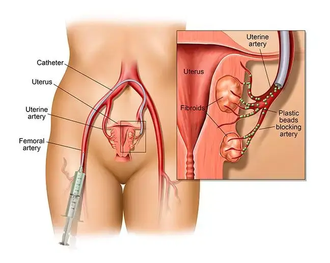 Uterine Fibroid Embolization