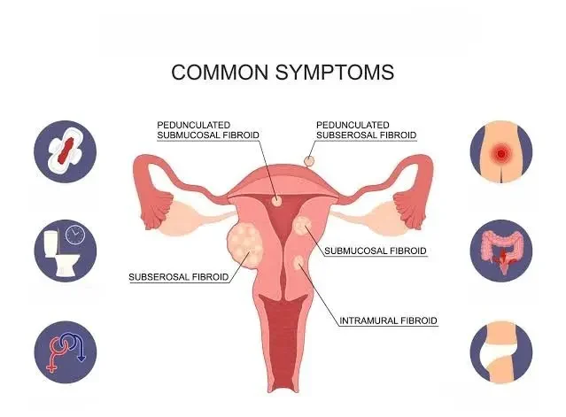 Common Symptoms Uterine Fibroid