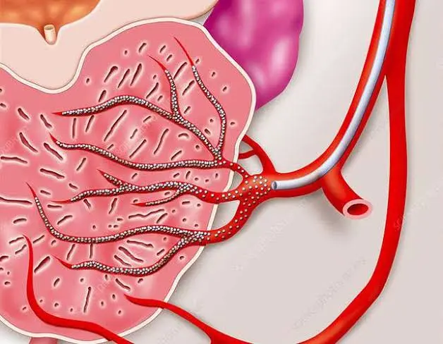 Prostate Artery Embolization