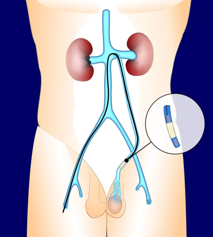 Varicocele Embolization
