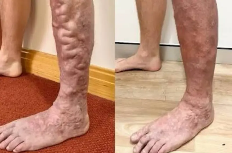 Varicose Veins
